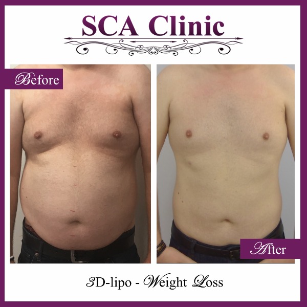 3D-lipo - Weight Loss